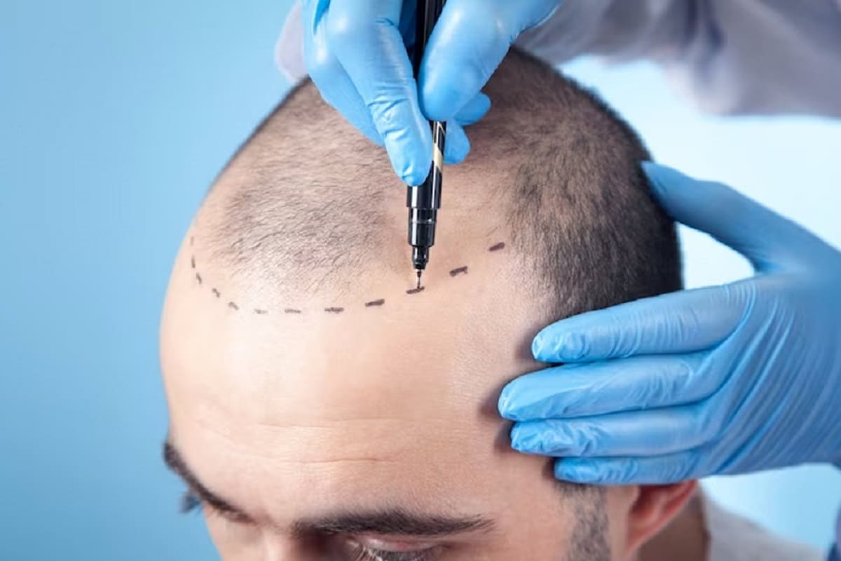 PROFESIONAL BACHELOR OF TRICHOLOGY AND HAIR TRANSPLANTATION
